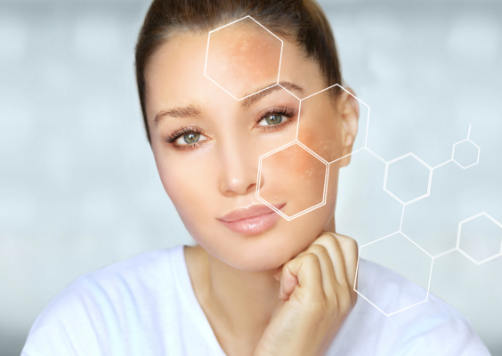 Your Guide to Melasma: Causes, Treatments, and the Benefits of Tinted Sunscreen